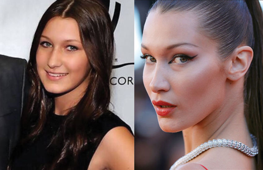 bella-hadid-nose-job-plastic-surgery-before-after-photos-pictures